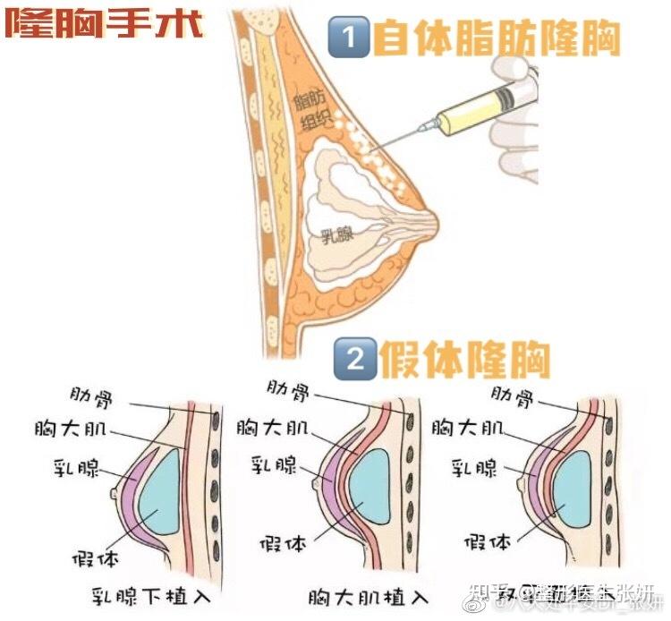 最新隆胸技术,最新隆胸技术，塑造完美曲线的新时代选择